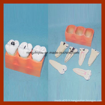 Modèle dentaire de décomposition des canies d&#39;étude dentaire